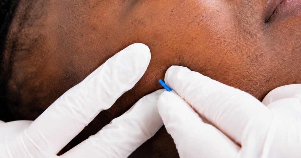 hirsutisme sopk electrolyse visage poils