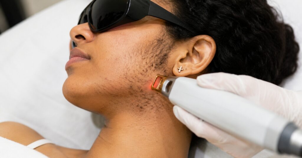 hirsutisme sopk traitement laser visage